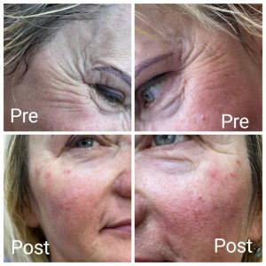 حقن بوتكس في رأس غارب